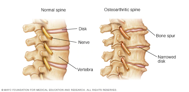 normal spine photo compared to osteoarthrititic spine photo