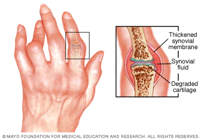 Rheumatoid Arthritis Hand