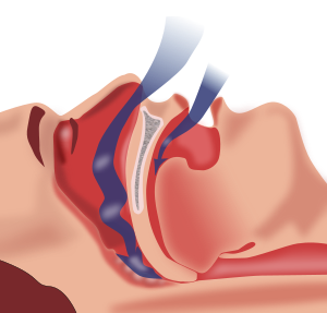 blocked airways