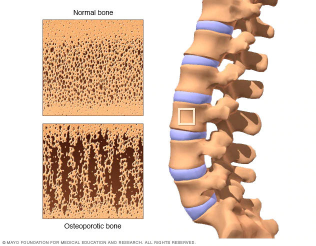 Osteoporosis Bones