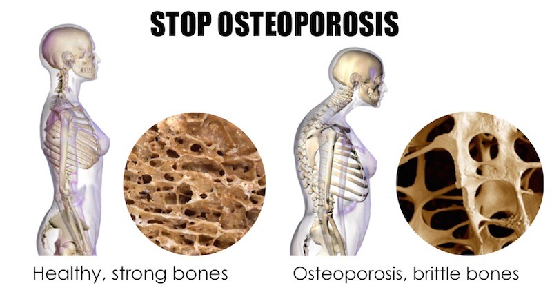 Osteoporosis Health Spine