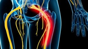 Illustration of sciatic nerve pain.