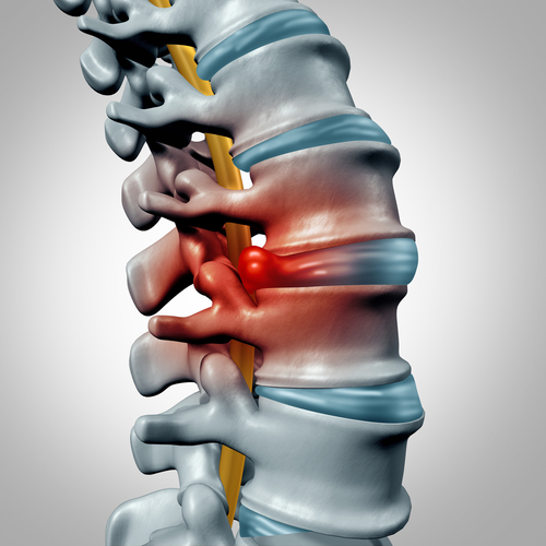 can a chiropractor fix a herniated disc