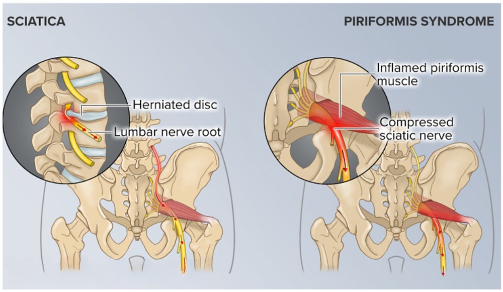 Comparison showing the two main causes of sciatica: disc herniation compressing the nerve (left) versus piriformis syndrome.
